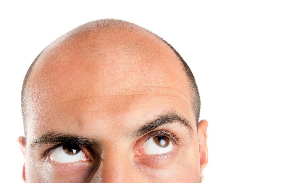 O algoritmo da calvície. Genes ajudam a prever a perda de cabelo em homens