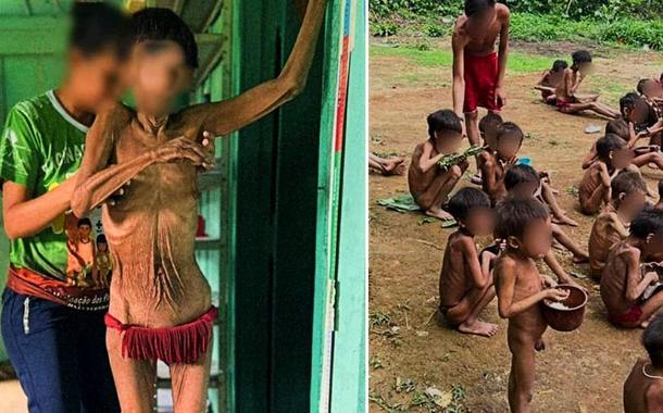 Índios ianomâmis com desnutrição severa em Roraima