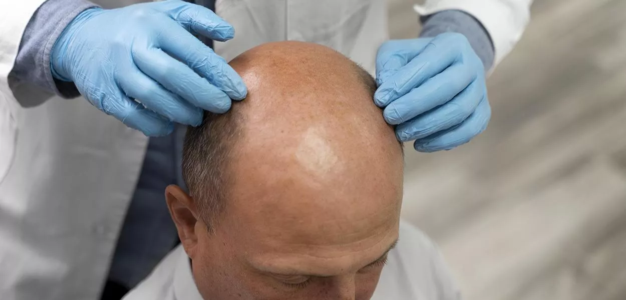 Fim da calvície? medicina chinesa ancestral que usa raiz é a aposta do momento