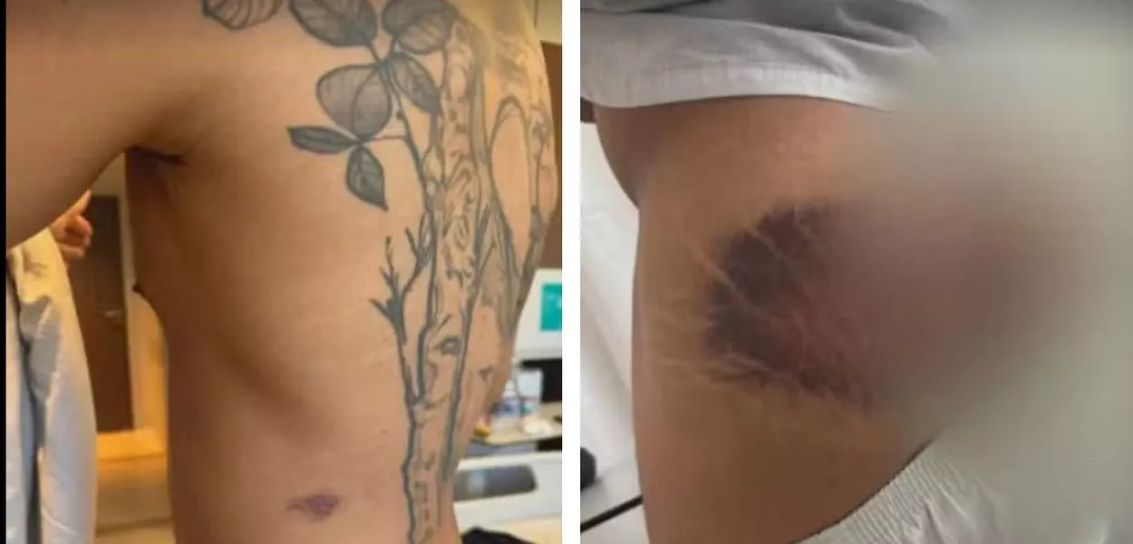 Hematoma em um soldado 