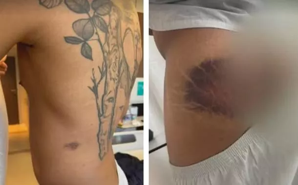 Hematoma em um soldado 