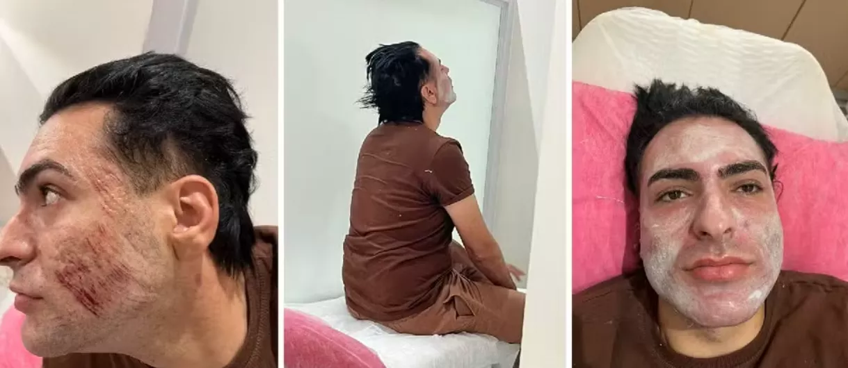 Peeling de fenol: laudo aponta edema pulmonar agudo como causa de morte de empresário
