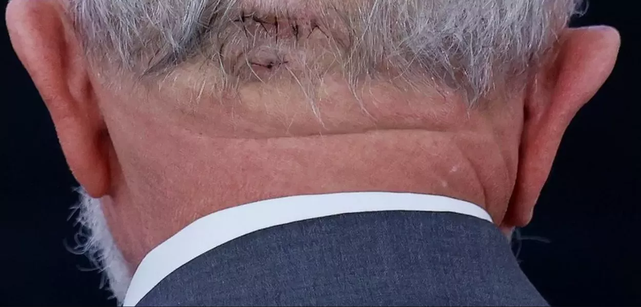 Trepanação: entenda a cirurgia cerebral realizada em Lula