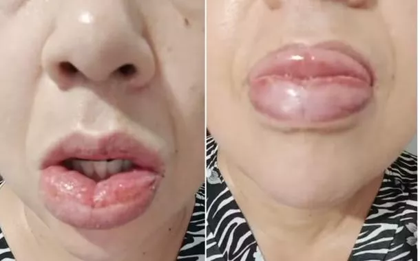Boca ficou com inchada após  uso do creme dental