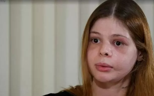 Médica que teve rosto destruído pelo ex-namorado perdeu parte da visão e passou por cirurgia para reconstruir a face