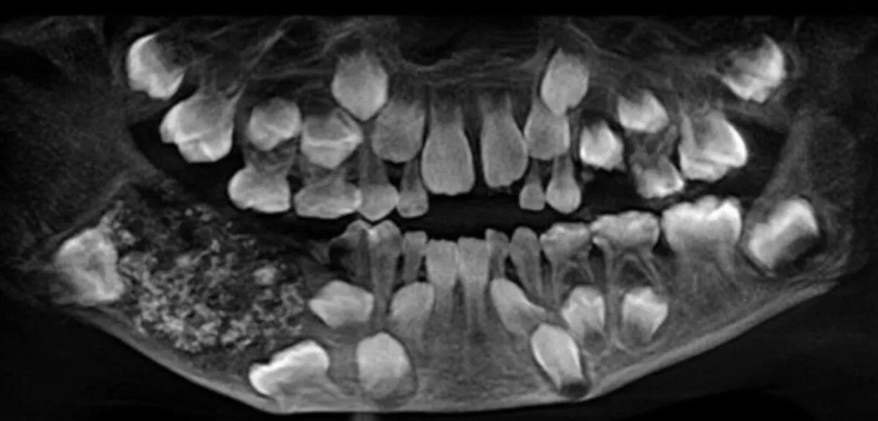 Caso raro de odontoma composto surpreendeu médicos em Chennai, na Índia, e entrou para a história da odontologia