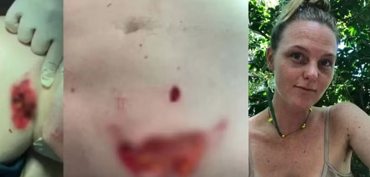 Fabiana permanece em casa, cuidando dos curativos e monitorando a evolução das lesões. Ela afirma que ainda processa o trauma e reconhece que o desfecho poderia ter sido “muito mais grave”.