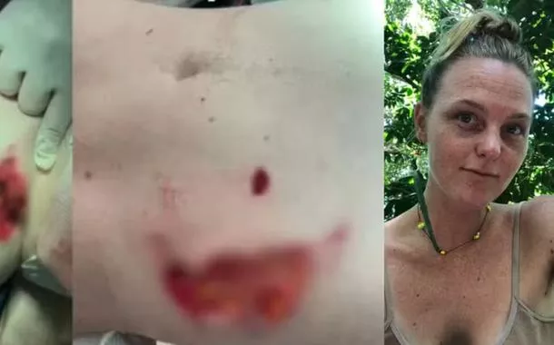 Fabiana permanece em casa, cuidando dos curativos e monitorando a evolução das lesões. Ela afirma que ainda processa o trauma e reconhece que o desfecho poderia ter sido “muito mais grave”.