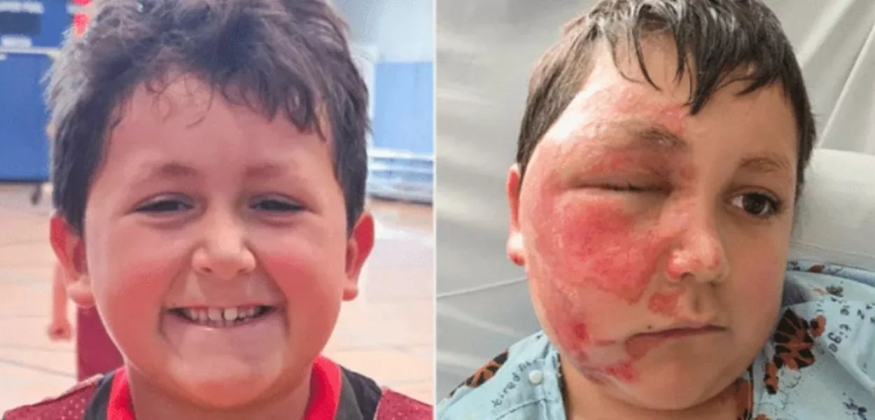 A explosão lançou a substância extremamente quente contra o rosto e as mãos do menino, que sofreu queimaduras severas